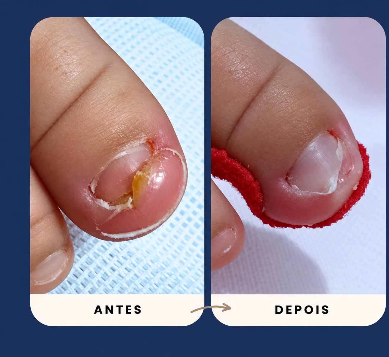 Comparação antes e depois de um atendimento podológico em unha infantil